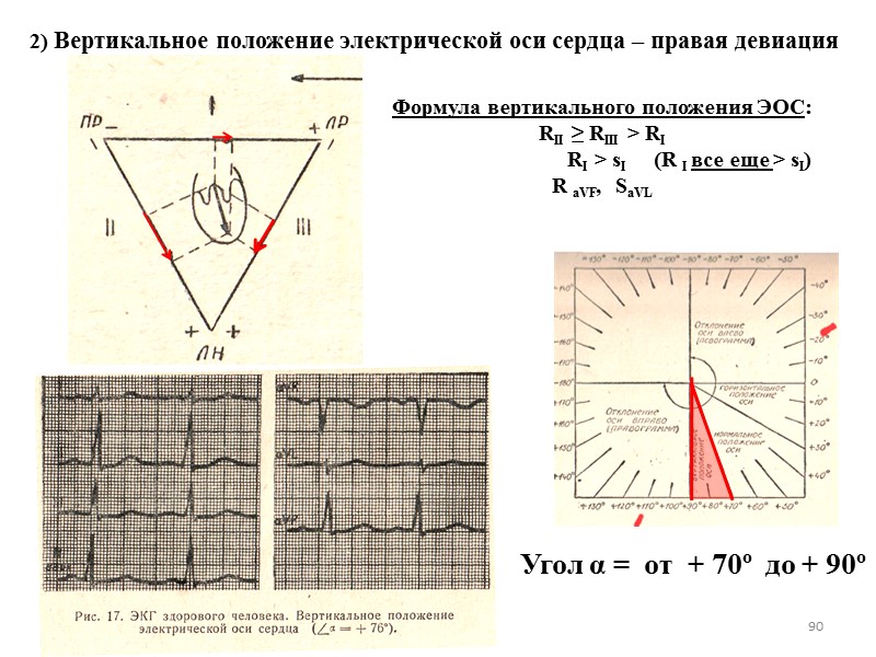 90 2) Вертикальное положение электрической оси сердца – правая девиация Формула вертикального положения ЭОС: